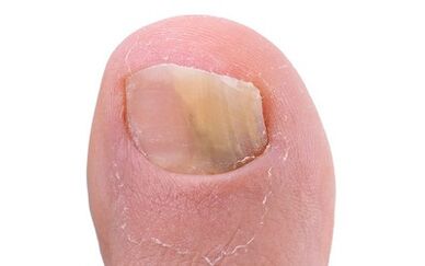 Symptômes de la présence de champignons sur le pouce de la jambe