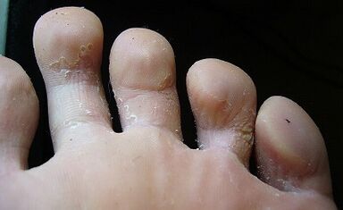 À quoi ressemble le champignon sur les jambes et comment la traiter
