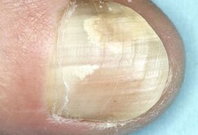 dommages à la plaque à ongles dus à une infection fongique
