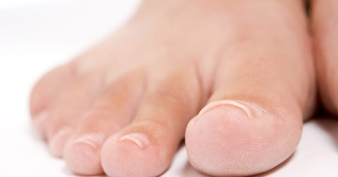 Les ongles des pieds peuvent être affectés par une infection fongique